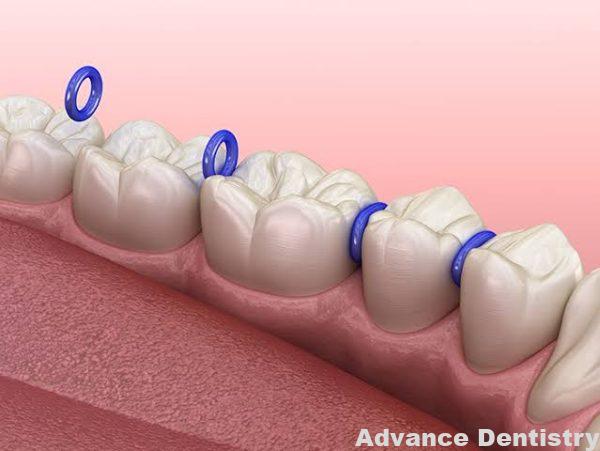 Orthodontics separtor