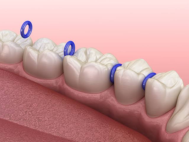 Orthodontics separtor